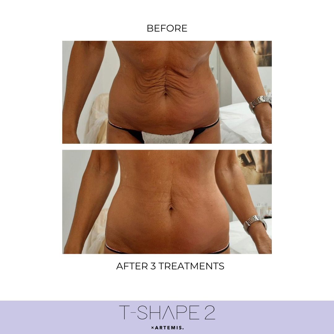T-Shape 2 before and after — Abdomen · Loose skin, After 3 treatments