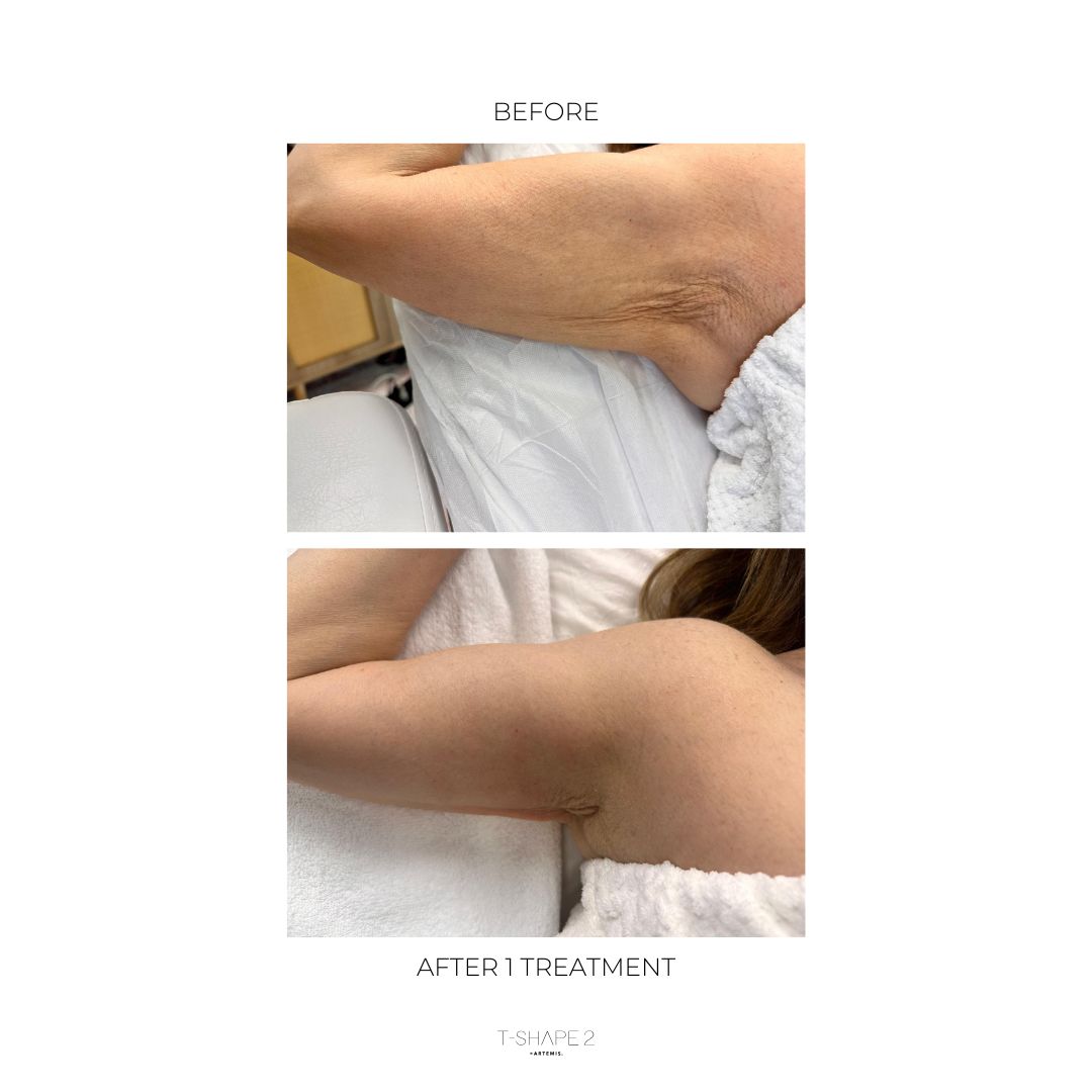 T-Shape 2 before and after — Arms · Skin tightening, After 1 treatment